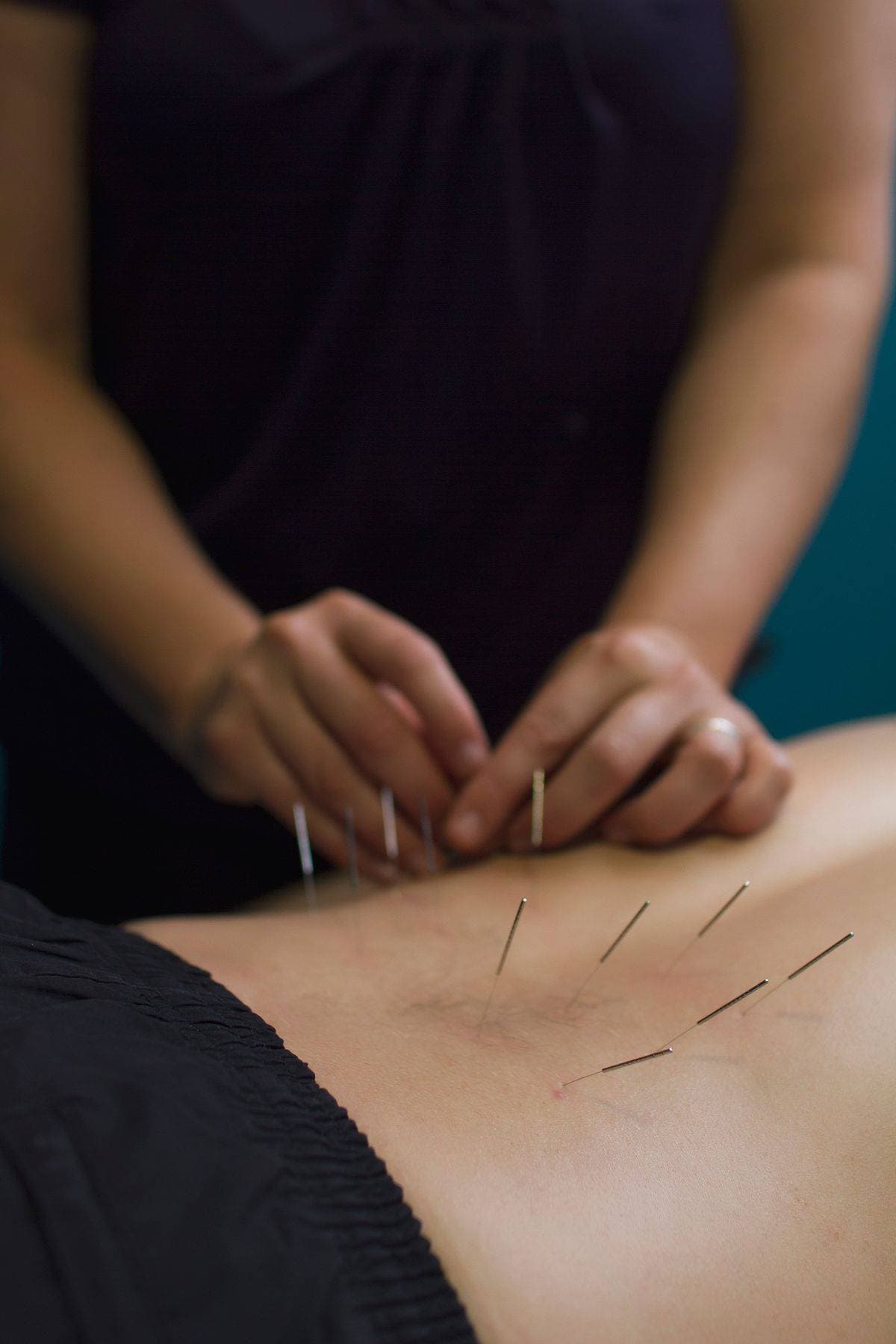 Acupuntura